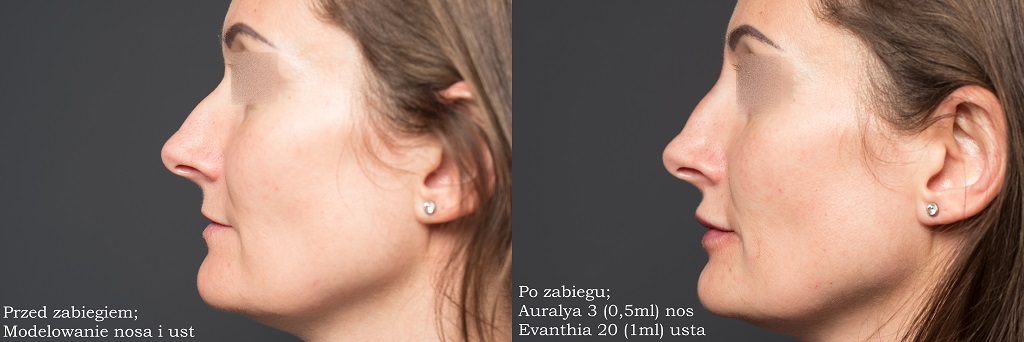 Użycie kwasu hialuronowego Auralya 3