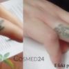 Efekty usuwania tatuażu
