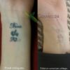 redukowanie tatuażu