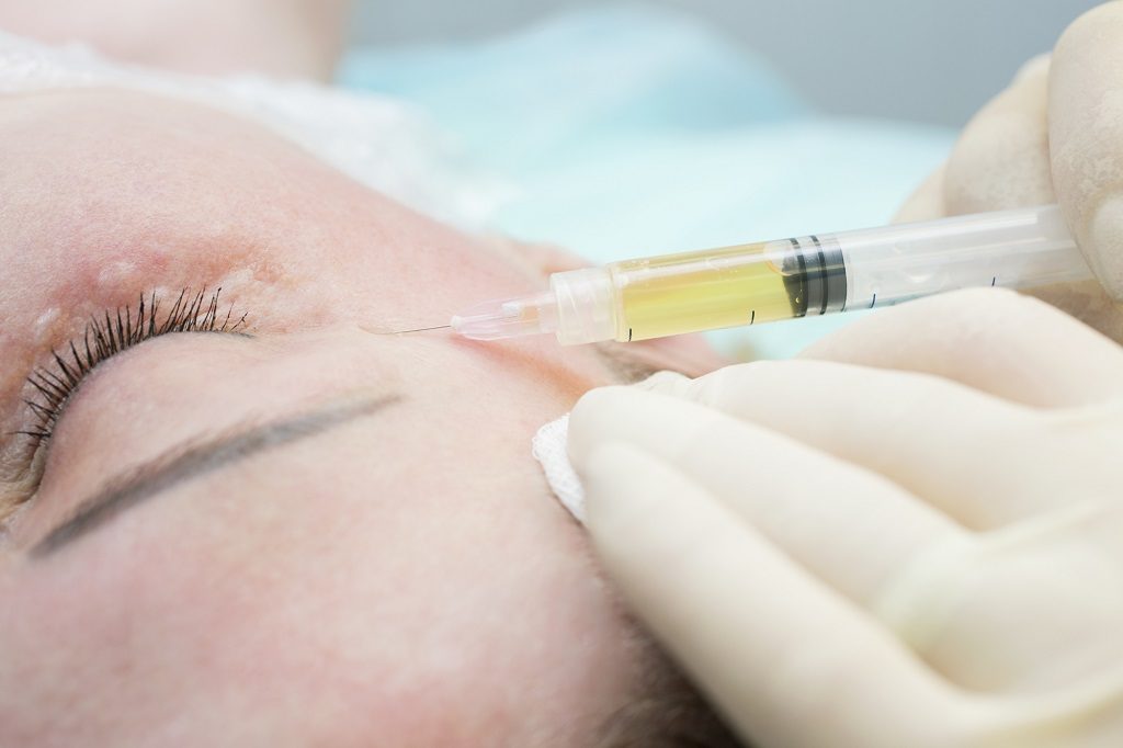 Mezoterapia osoczem bogatopłytkowym