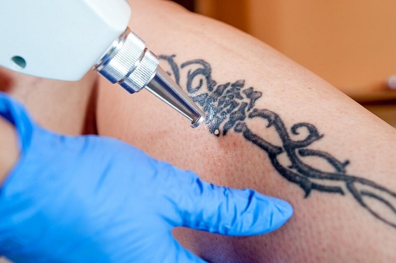 lasery do usuwania tatuażu