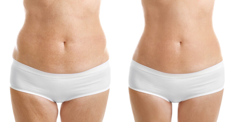 Lipolaser, liposukcja kawitacyjna, redukcja tkanki tłuszczowej
